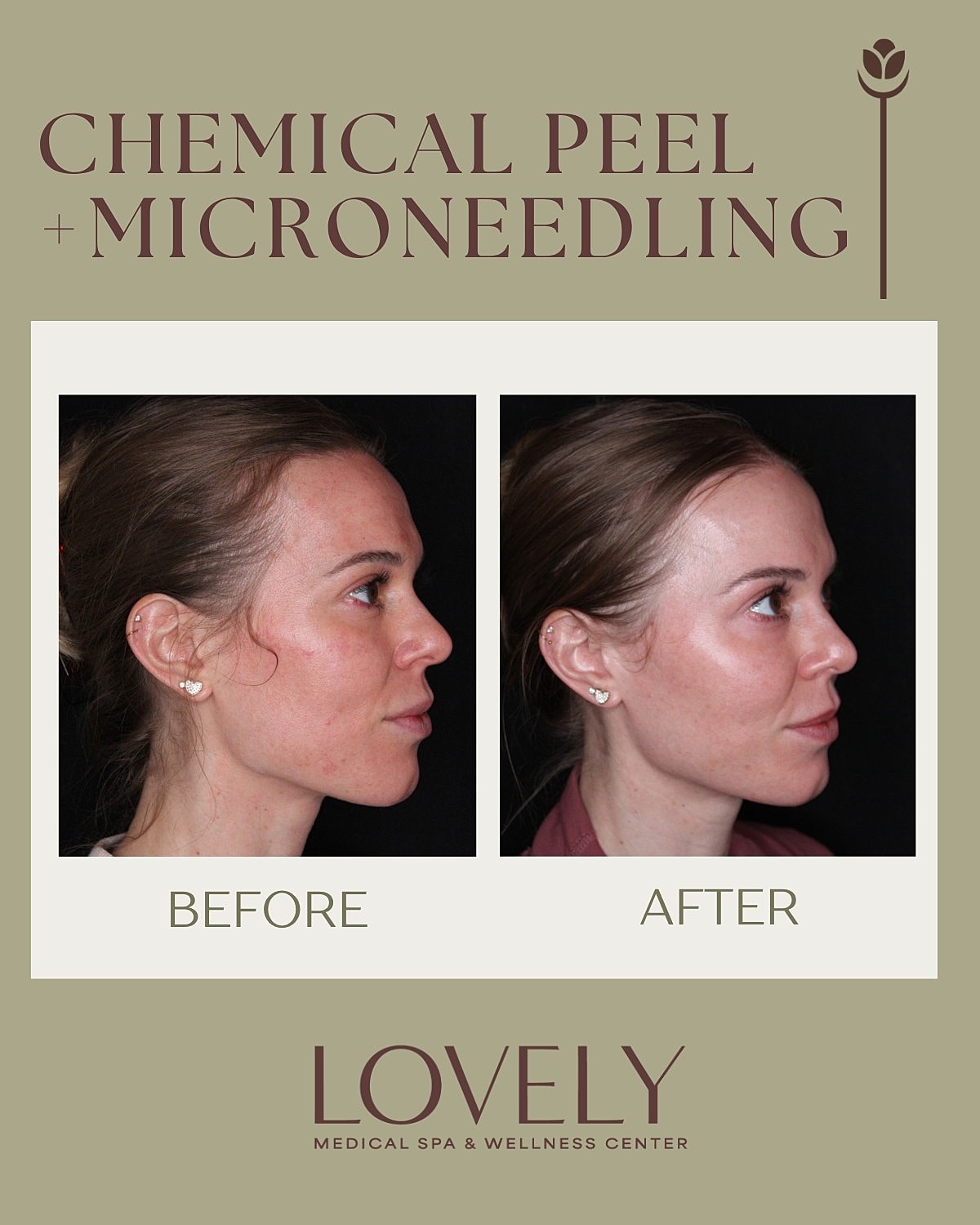 Before and after chemical peel and microneedling.