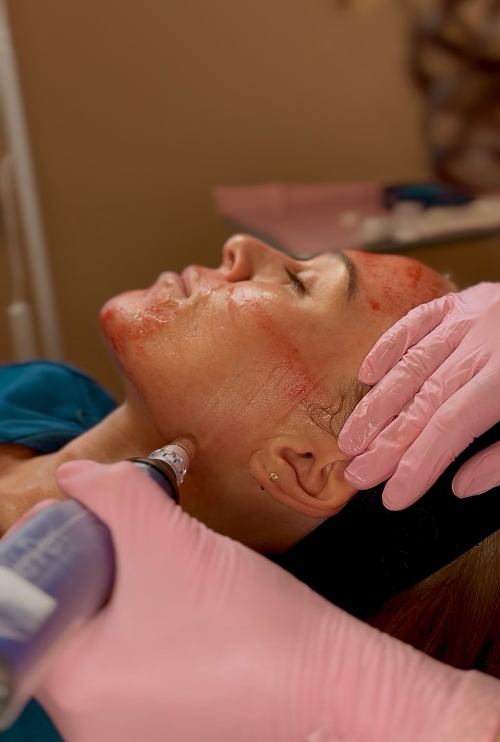 Facial treatment with microneedling procedure in progress.
