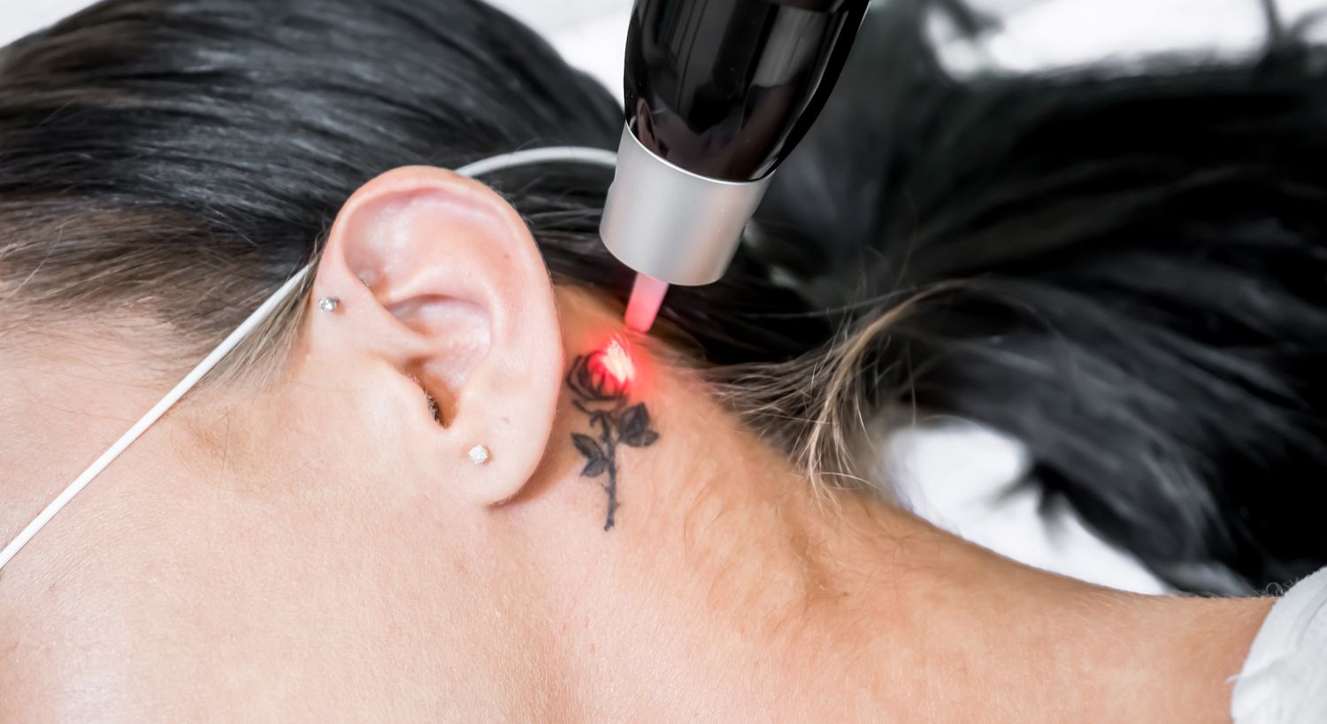 Laser tattoo removal in progress on neck.